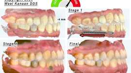 Invisalign Underbite Correction in Houston | Class III Expert