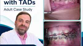 TAD open bite correction 
