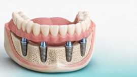 Illustration of a lower full-arch dental restoration supported by four dental implants