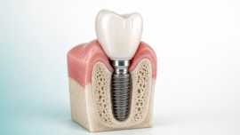 Signle Dental Implant with Titanium post and porcelean crown