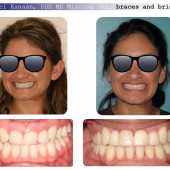 complex orthodontic case 1