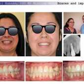 complex orthodontic case 2