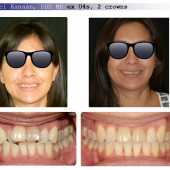 complex orthodontic case 3