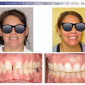 complex orthodontic case 4