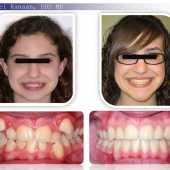 orthodontic case before and after