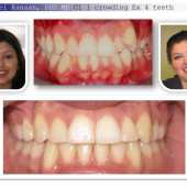 orthodontic case before and after