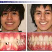 orthodontic case before and after
