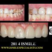 veneers case 5