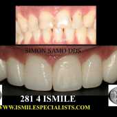 veneers case 4