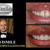 veneers case 3