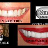 veneers case 1