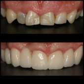 veneers case 2