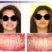 orthodontic case before and after