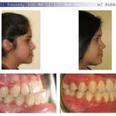 orthodontic case before and after