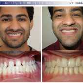 orthodontic case before and after