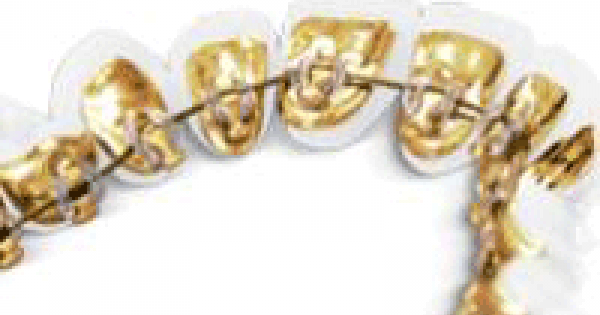 Lingual Incognito Braces Ismile Specialists