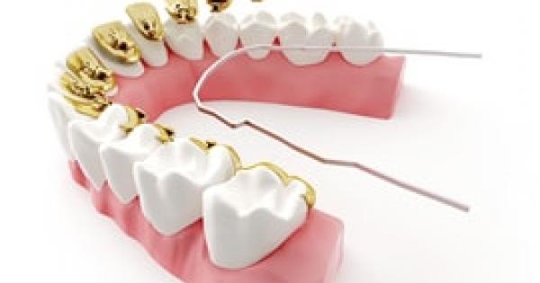 Lingual Braces Cost Houston, TX 2020 | iSmile Specialists Lingual Braces Cost Houston, TX 2020 | iSmile Specialists