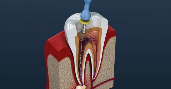 Root Canal In Houston Tx Root Canal Cost 2021