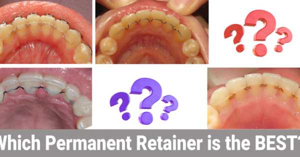 Permanent Retainers in Sugar Land, TX | iSmile Specialists