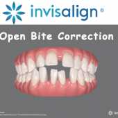 Anterior open bite correction with Invisalign in Houston