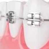3D Image of braces