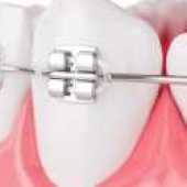 3D Image of braces