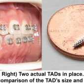 TADs in Houston Orthodontist mini implants