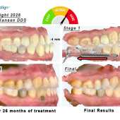 Invisalign Underbite Correction in Houston | Class III Expert
