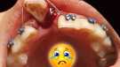 Trauma to a front tooth